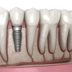A Journey Into the World of Mini Dental Implants