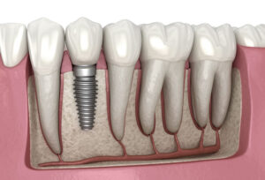A Journey Into the World of Mini Dental Implants