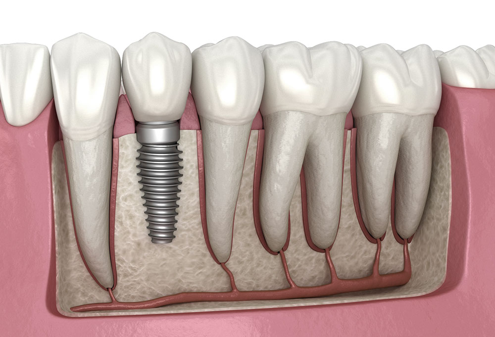 A Journey Into the World of Mini Dental Implants