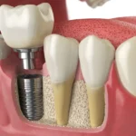 Harnessing Mindfulness for a Stress-Free Dental Implant Experience