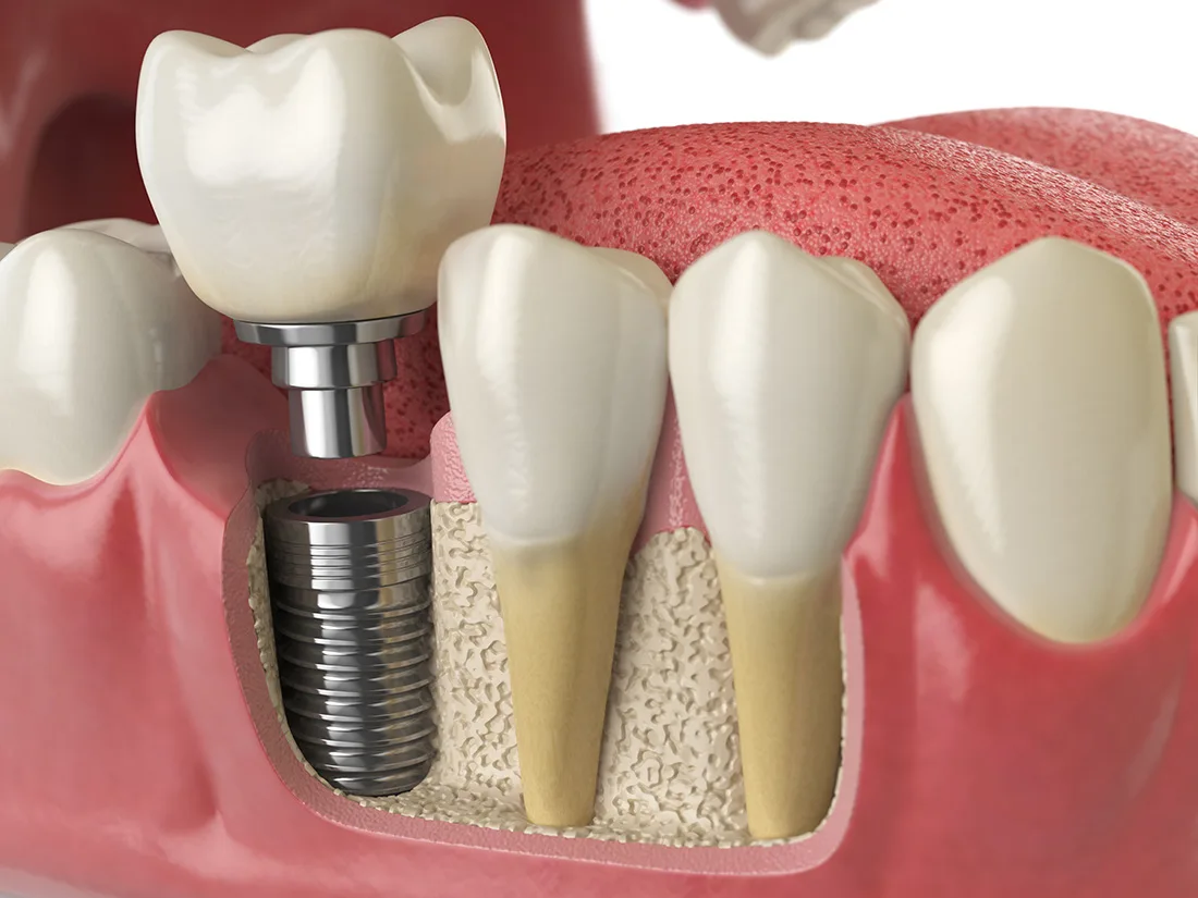 Harnessing Mindfulness for a Stress-Free Dental Implant Experience