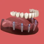 How Smoking Cessation Programmes Improve Dental Implant Success Rates
