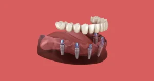 How Smoking Cessation Programmes Improve Dental Implant Success Rates