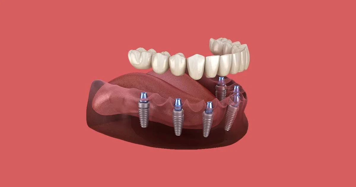 How Smoking Cessation Programmes Improve Dental Implant Success Rates